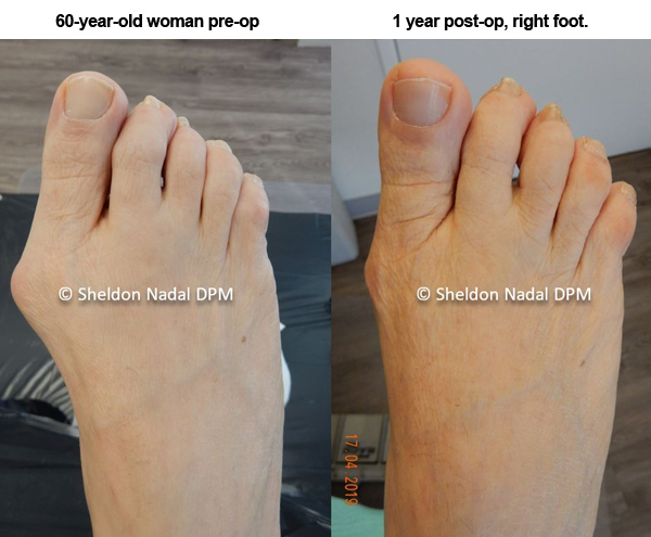 Before And After Bunions Bunionettes Sheldon H Nadal D P M